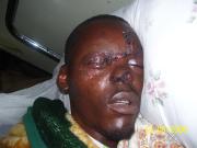 Fred immediately after his accident. Nkumba Ministries paid his medical bills.