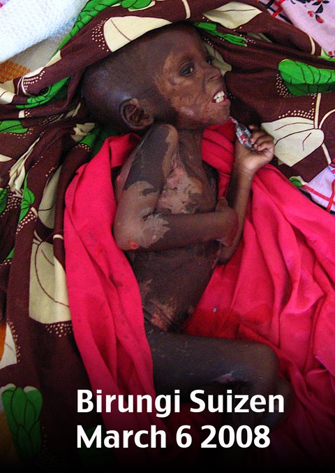 Birungi- prior to treatment by Drs. Scott and Jennifer Myhres in Uganda