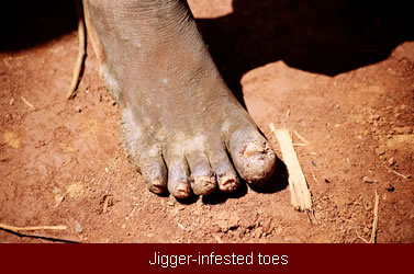jigger-infected_toes